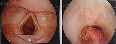 Case Report: Defect repair post-resection of cervical tracheal granular cell tumor by cervical anterior banded myofascial flap: A case study and literature review